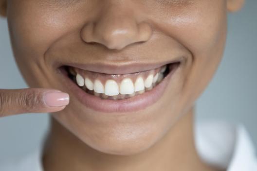 Gummy smile
