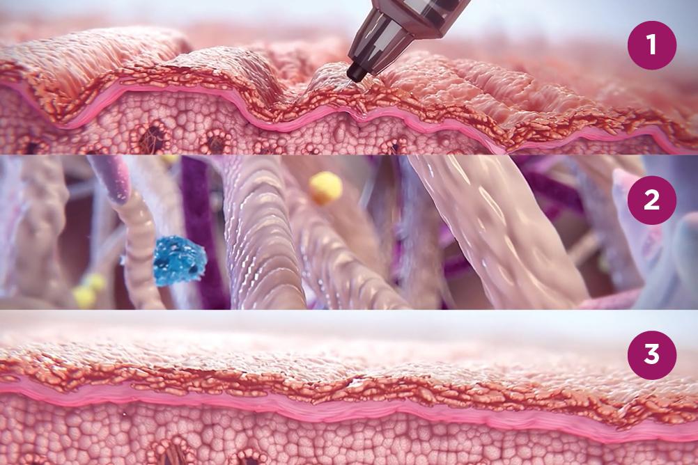 Sculptra treatment