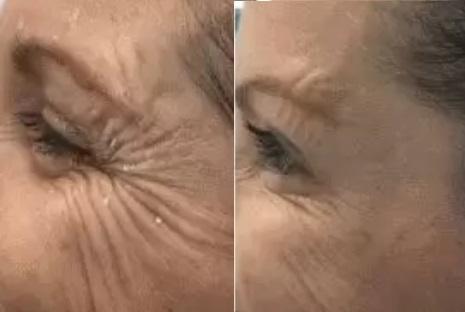 Wrinkle removal before and after photo