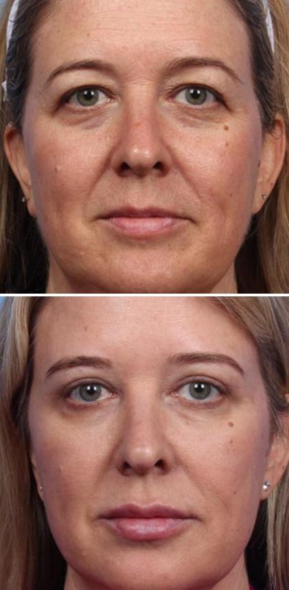 wrinkles-under-eyes