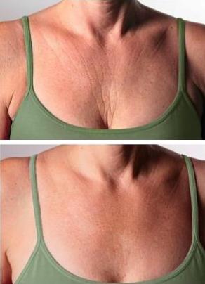 Profhilo cleavage before and after