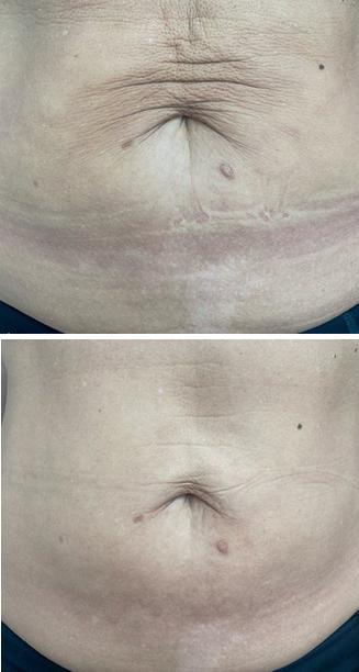 Profhilo result belly