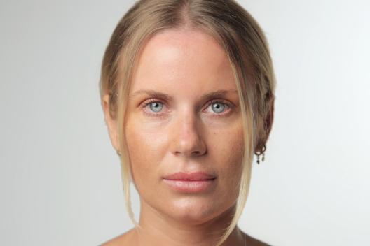 Treat nasal wings with Botox