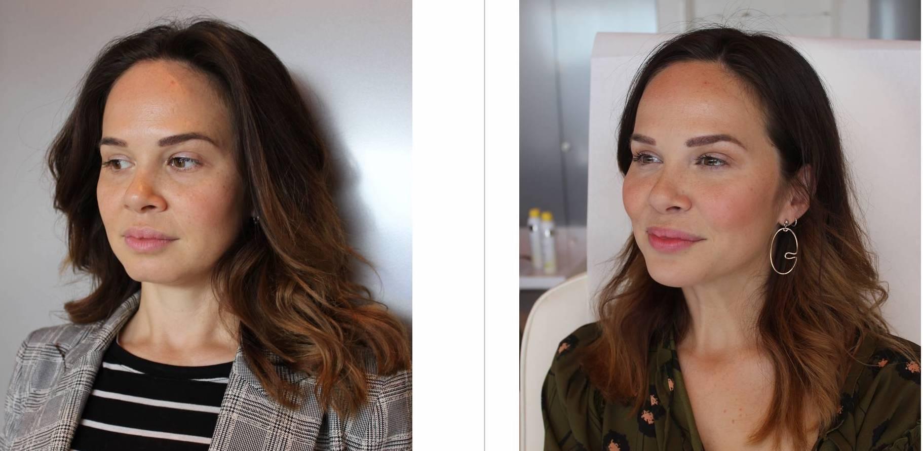 jawline fillers before and after