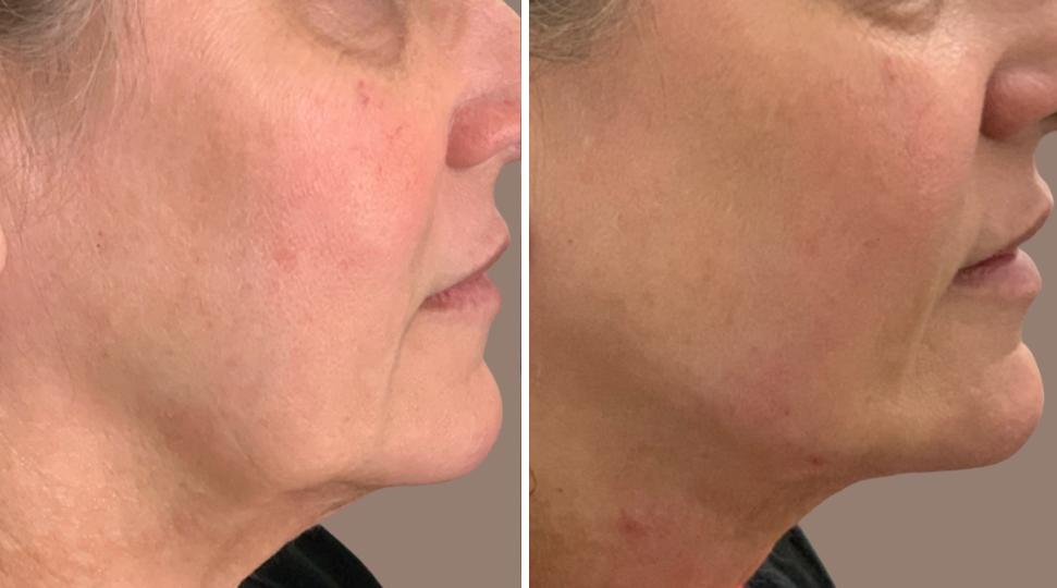 jawline filler photo