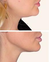 Jawline before and after photo