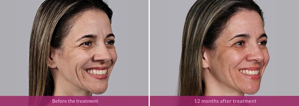 Before and After