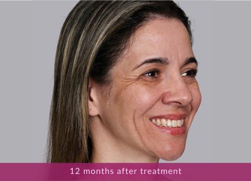12 months after treatment