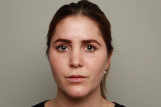 Voorfoto - lipfiller (1)