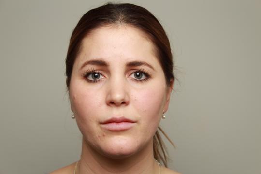 Nafoto - lipfiller (1)