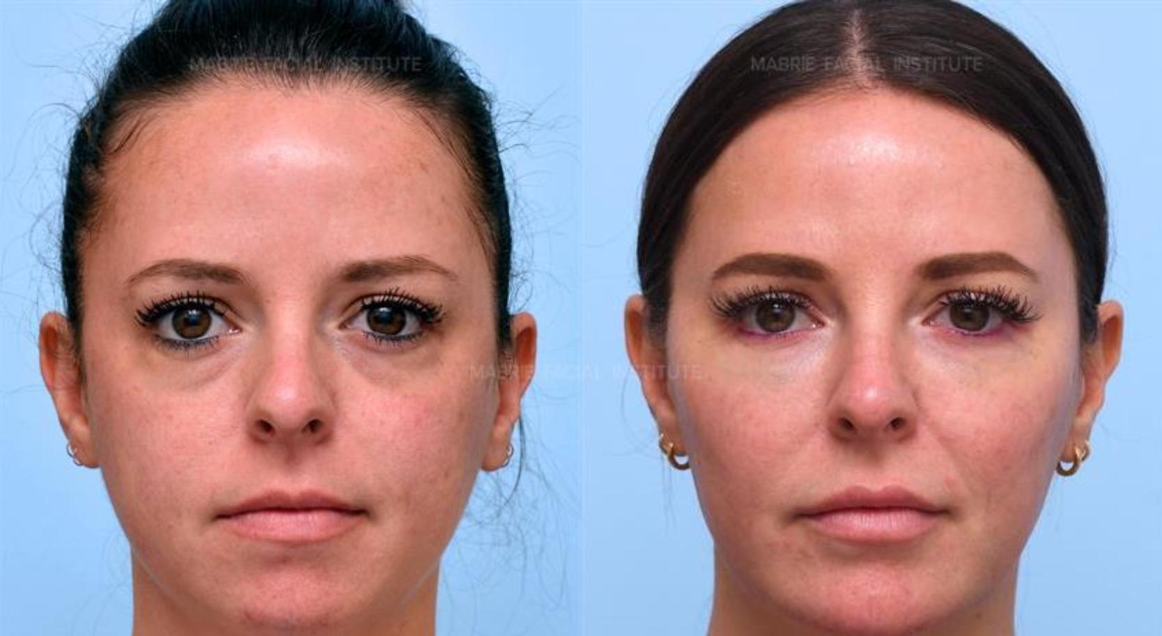 Radiesse experiences