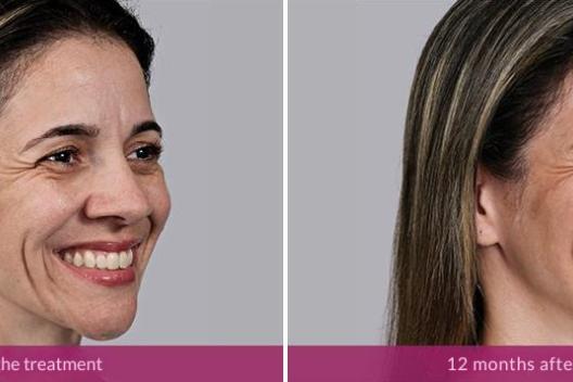Sculptra reviews