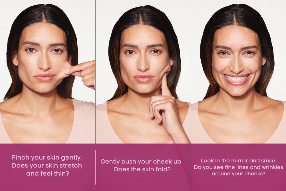 Sculptra treatment