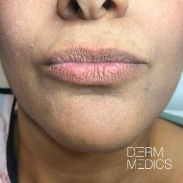 Before lipfiller Derm Medics