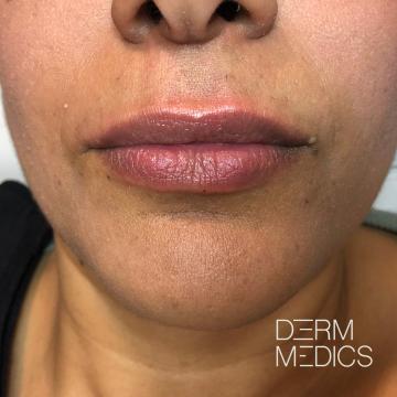 After lipfiller Derm Medics