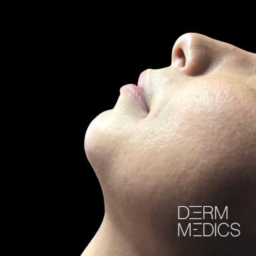 Before kin en lipfiller voor harmony en assymetrie correctie