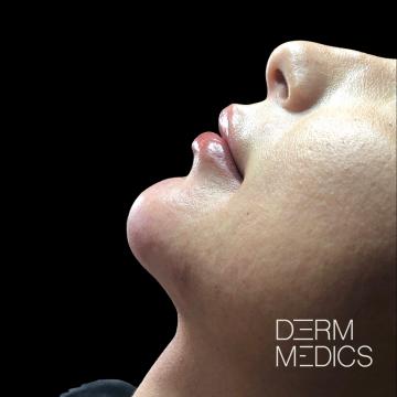After kin en lipfiller voor harmony en assymetrie correctie