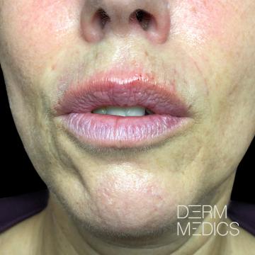 After lipfiller fixen van assymeterie