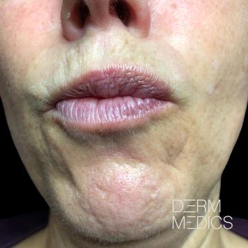 Lippen foto van Derm Medics (voor)