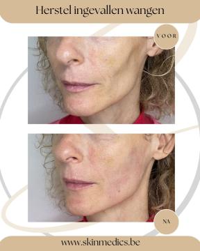 Wangen foto van SkinMedics Clinic Brugge (na)