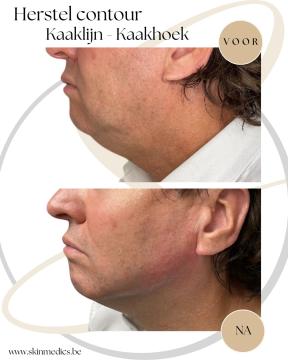 Kin- en kaaklijn foto van SkinMedics Clinic Brugge (na)