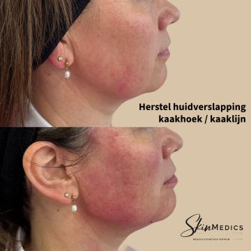 Kin- en kaaklijn foto van SkinMedics Clinic Brugge (voor)