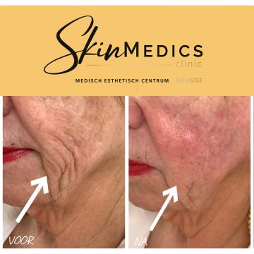 Wangen foto van SkinMedics Clinic Brugge (voor)