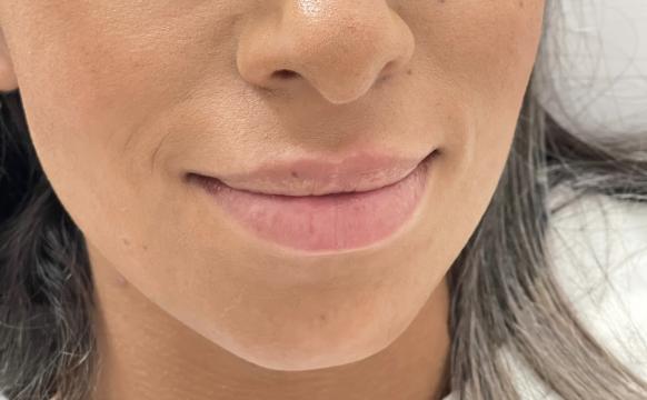 Lippen foto van SW Clinic (voor)