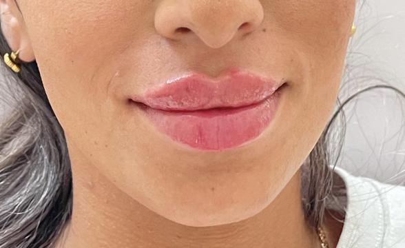 Lippen foto van SW Clinic (na)