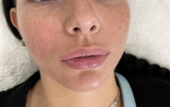 Lippen foto van SW Clinic (voor)