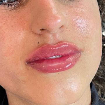 Lips picture of SW Clinic (after)