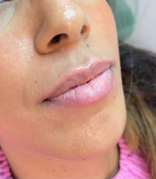 Lippen voor/na van SW Clinic (voor)