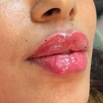 Lippen voor/na van SW Clinic (na)