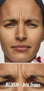 Fronsrimpels voor/na van Blush injectables kliniek (voor)