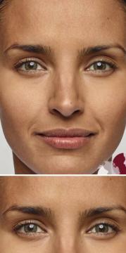 Fronsrimpels voor/na van Blush injectables kliniek (na)