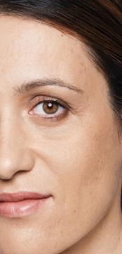 filler-behandeling-traangootwallen-voor