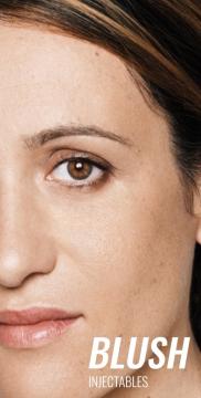 filler-behandeling-traangootwallen-na