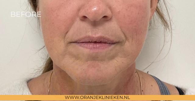 Neus-lippenplooi voor/na van OranjeKlinieken Amersfoort (voor)