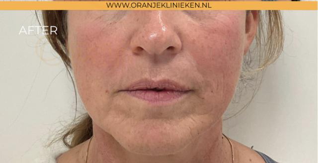 Neus-lippenplooi voor/na van OranjeKlinieken Amersfoort (na)