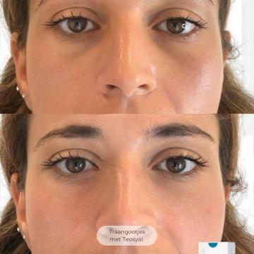 Traangoot / wallen onder ogen foto van De Gezichtskliniek - Amsterdam (voor)