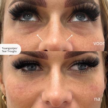 Traangoot / wallen onder ogen foto van De Gezichtskliniek - Amsterdam (na)