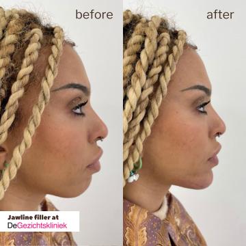 Kin- en kaaklijn foto van De Gezichtskliniek - Utrecht (na)