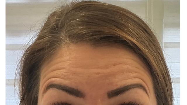 Voorhoofdsrimpels voor/na van Roya Clinics (voor)