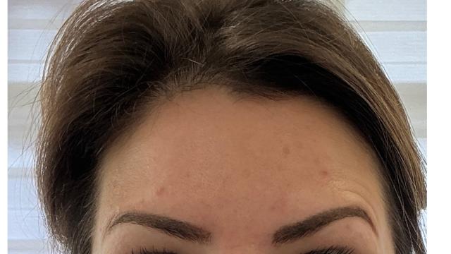 Voorhoofdsrimpels voor/na van Roya Clinics (na)