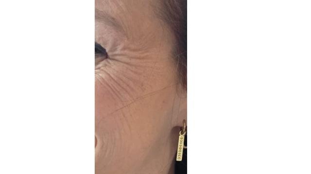 Kraaienpootjes voor/na van Roya Clinics (voor)