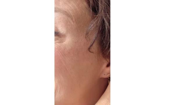 Kraaienpootjes voor/na van Roya Clinics (na)