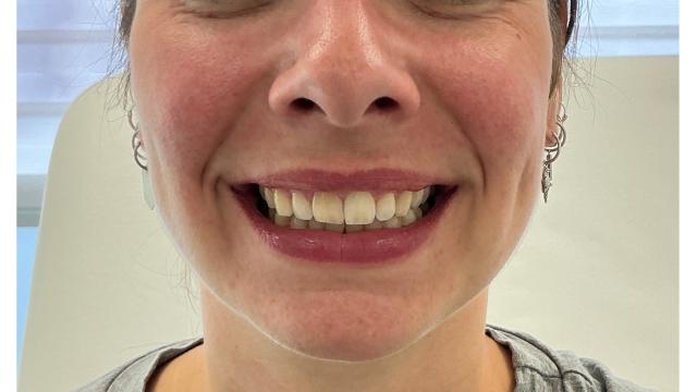 Lipflip voor/na van Roya Clinics (na)