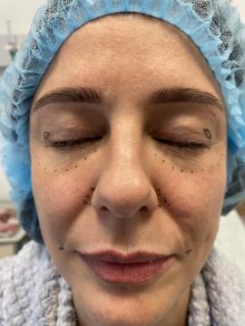 Ooglid chirurgie foto van Zarina Clinic (voor)