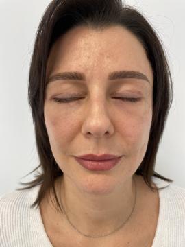 Ooglid chirurgie foto van Zarina Clinic (na)