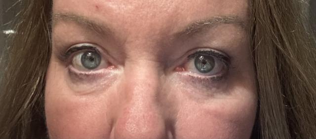 PolyPhil voor/na van Botoluxery and Moreirene (na)